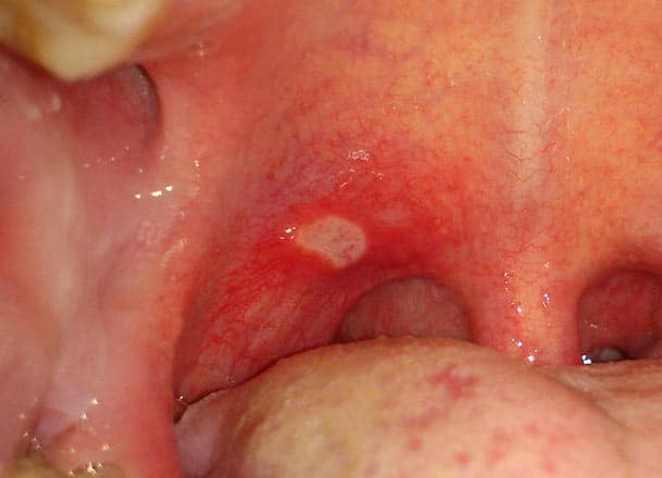 Bump On Roof Of Mouth Small Hard Painful White Red Lump On Palate 