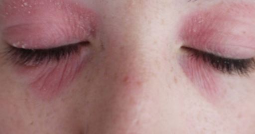sunburned eyeballs symptoms