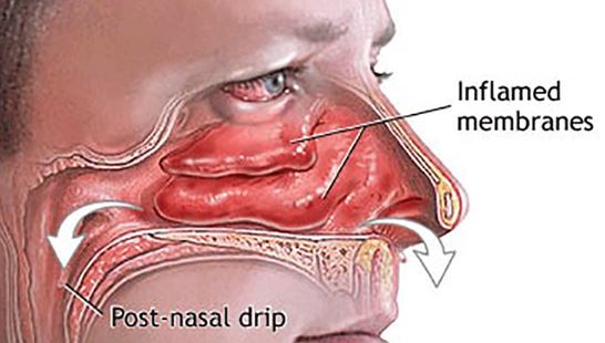 How To Clear A Stuffy Nose Fast Instantly Or Overnight Naturally With 