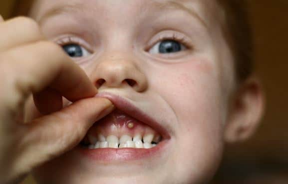 Pimple On Gums After Root Canal No Pain White Bumps On Gum Line Above 