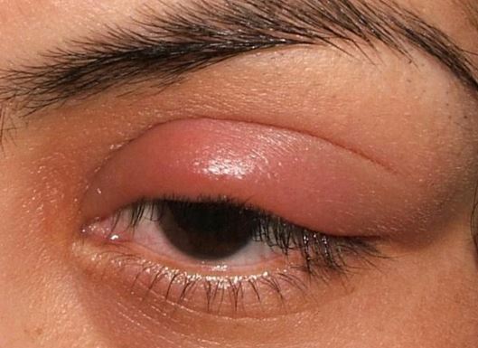 Eye Pain When Blinking Why Hurt Sharp Pain In Left Eye Socket When I 