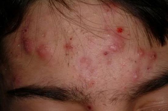 Infected Pimple (on Face, Nose, Leg): From Staph, Yeast 