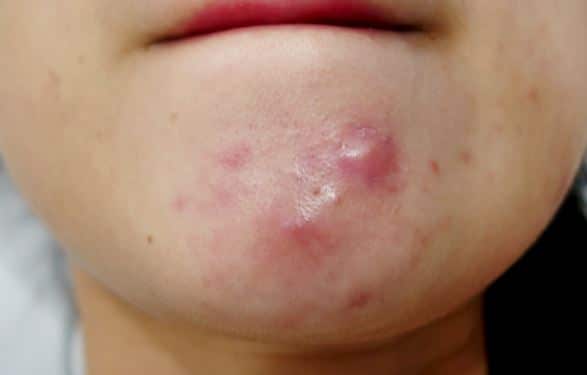 Pimples On Chin Causes Under Chin Hard Painful Get Rid Of Small Deep 