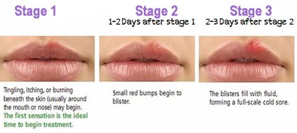 Cold Sore Stages Pictures Timeline Early Contagious Healing Scab 