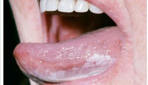 leukoplakia thrush lesions bumps tobacco chewing dermnet coating tumors buccal sores treatment zealand leukoplakie kanker lidah symptome diagnosis dipping rehabilitasi