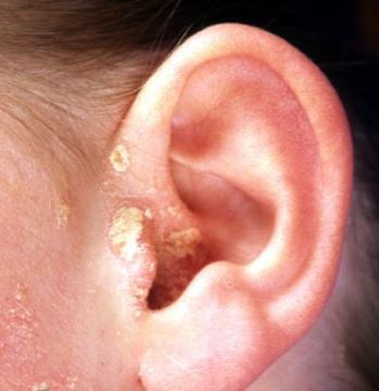 inner ear itch wheat allergy