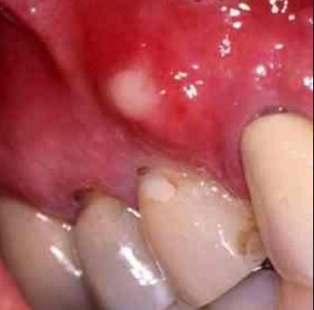 white-bump-on-gums