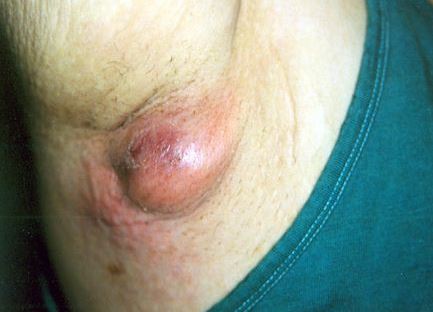 armpit-cysts