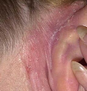 that inner ear itch