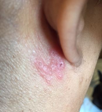 Shingles rash behind ear