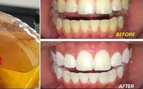 Apple cider vinegar teeth whitening