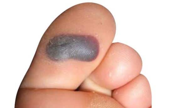 Blood blister at bottom of toe