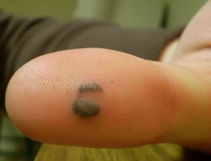 Blood blister on finger pictures