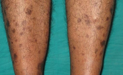 Brown Spots On Legs Lower Legs Get Rid Of Little Light Brown Dots On 