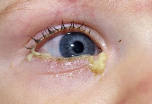 Toddler Eye Discharge Causes Fever Green Yellow Cold Infection 