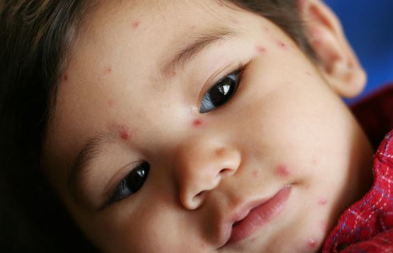 Red Freckles on Face