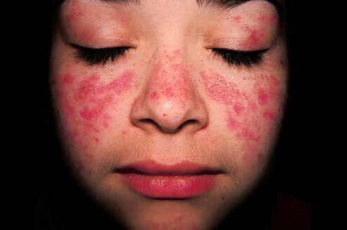 Red Freckles on Face