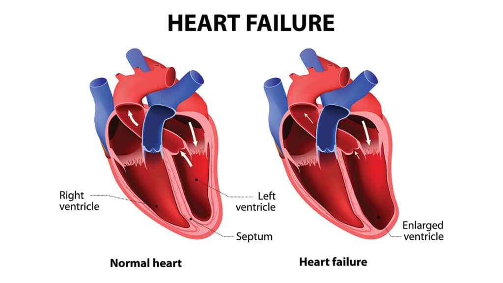 systolic haert failure