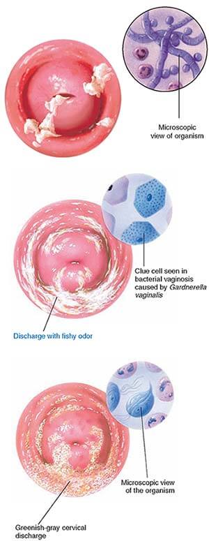 Bacterial Vaginosis