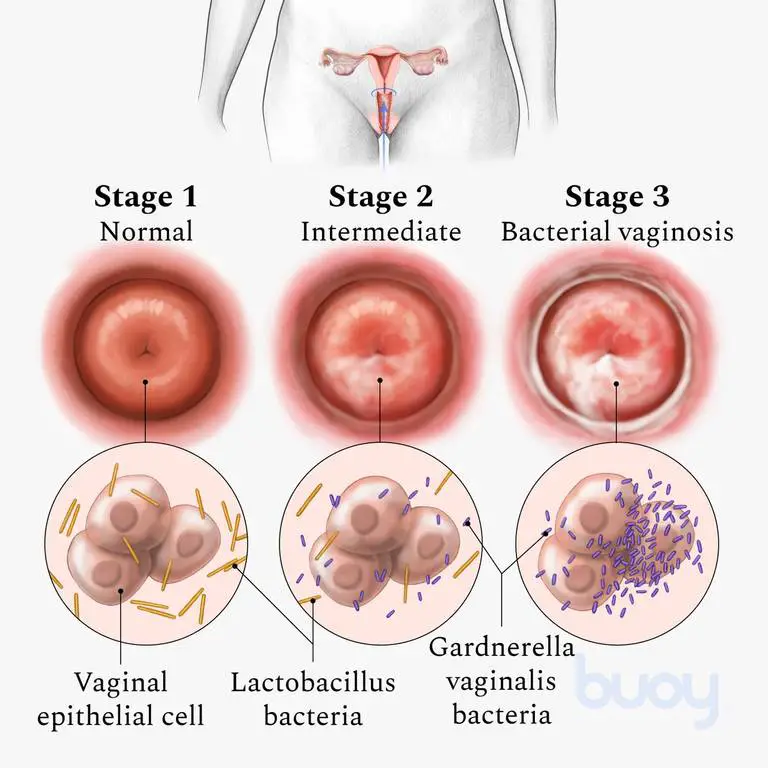 bacterial vaginosis